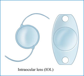 Cataract Surgery in Kalaburagi