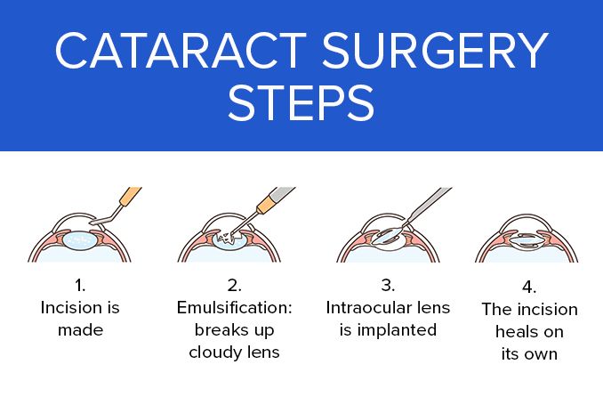 Cataract Surgery in Kalaburagi