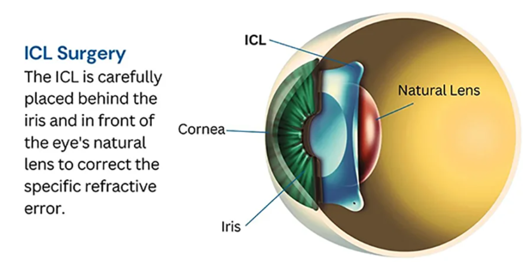 ICL Surgery in Gulbarga